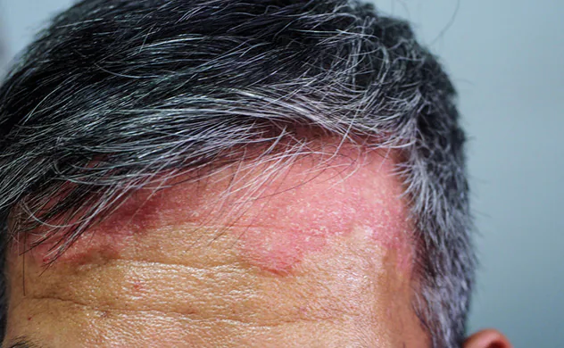 Scalp psoriasis 