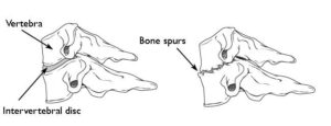 illustrations of healthy and degenerated cervical disks